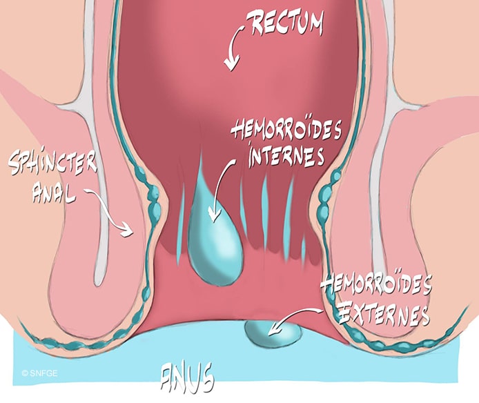 hémorroïde externe : causes et solutions